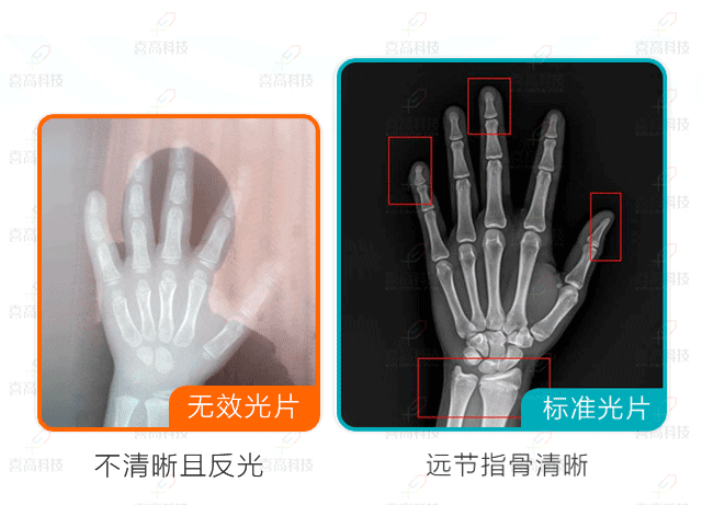 網(wǎng)上問診需要提供什么樣的骨齡片？.gif